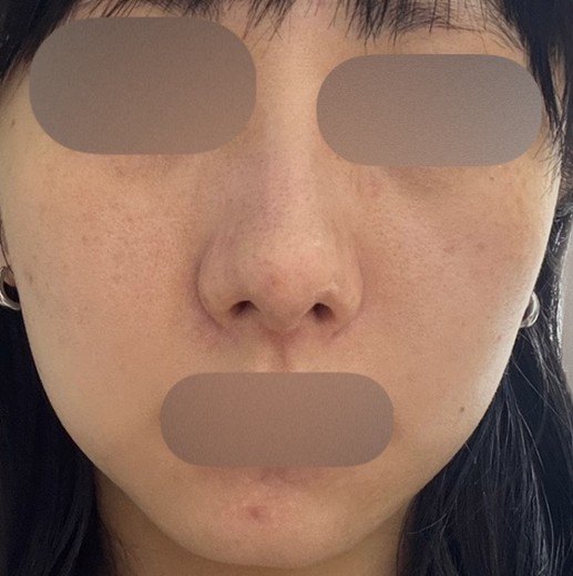 before photo: ララピール(LHAピーリング)