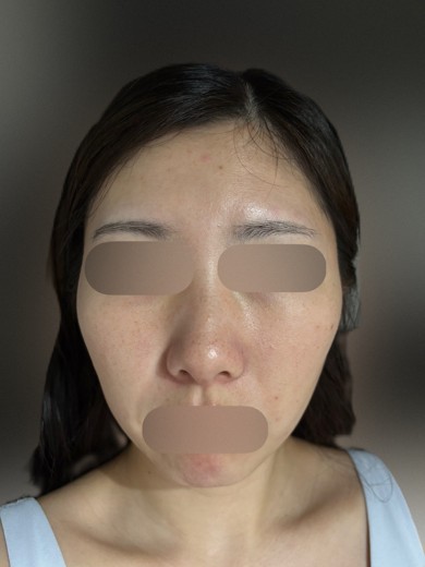 before photo: ヴェルベットスキン