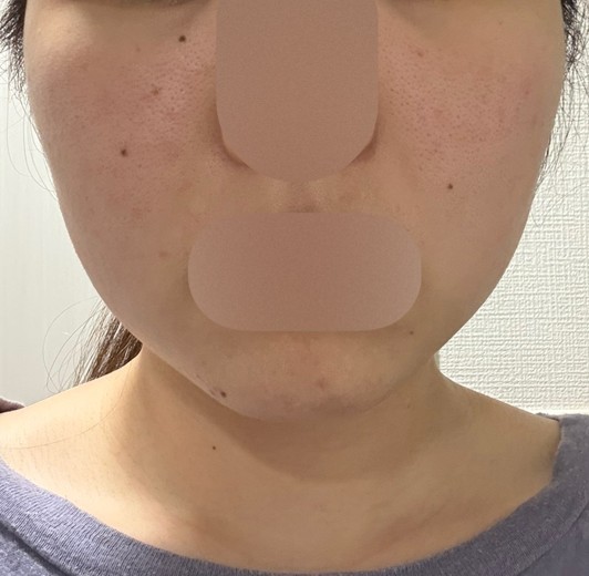 after photo: ピーリング