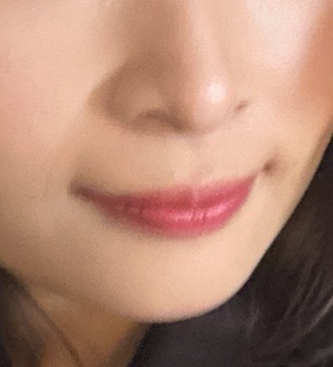 before photo: ほうれい線ヒアルロン酸