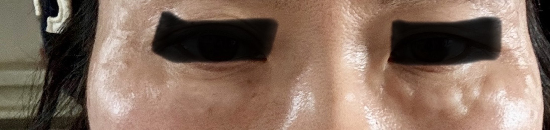 after photo: 리쥬란아이