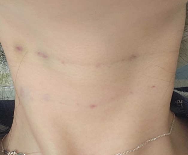 after photo: 풀페이스필러