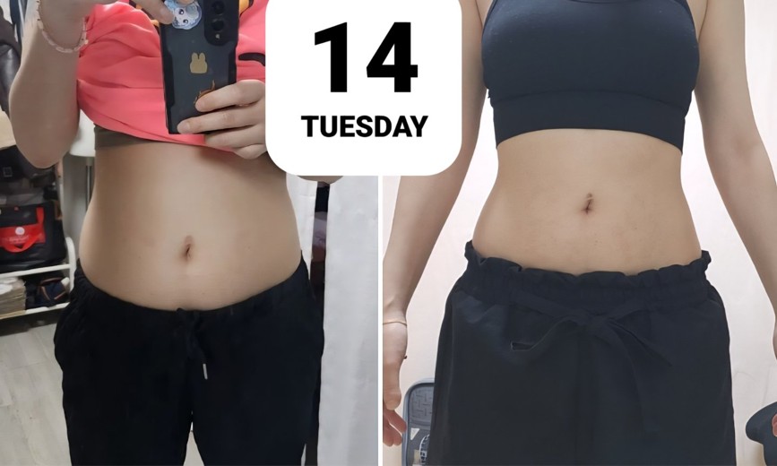 after photo: 복부지방분해주사, 팔지방분해주사