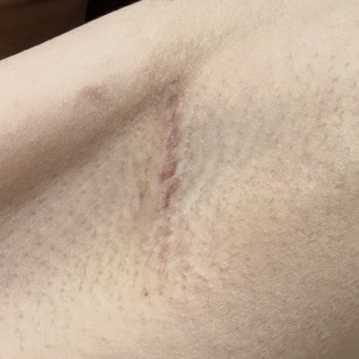 after photo: 豊胸(シリコンバッグ)