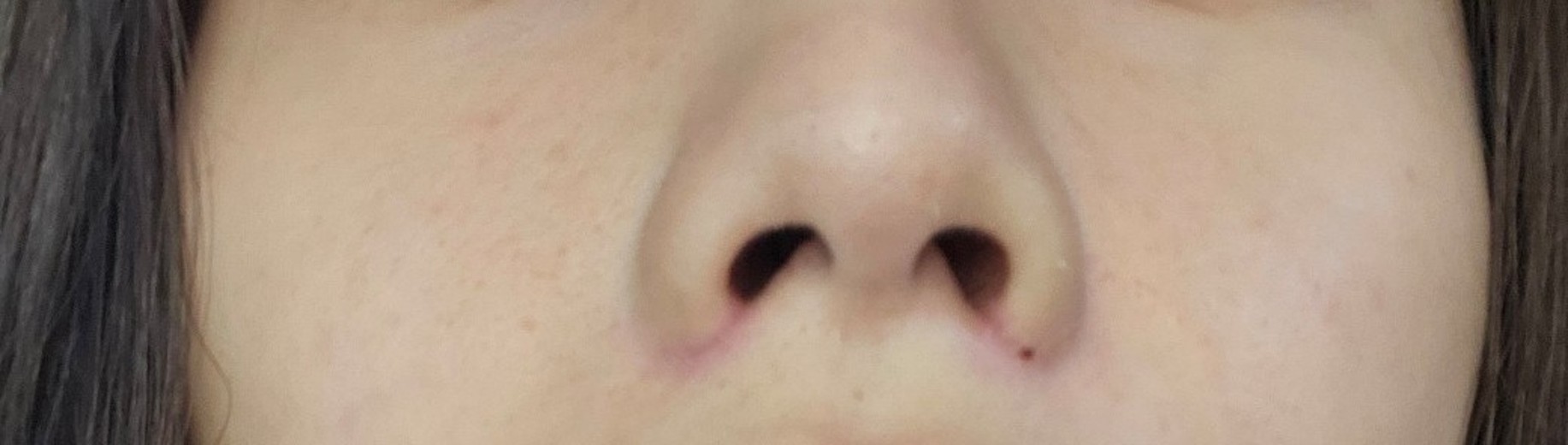 after photo: 콧볼축소