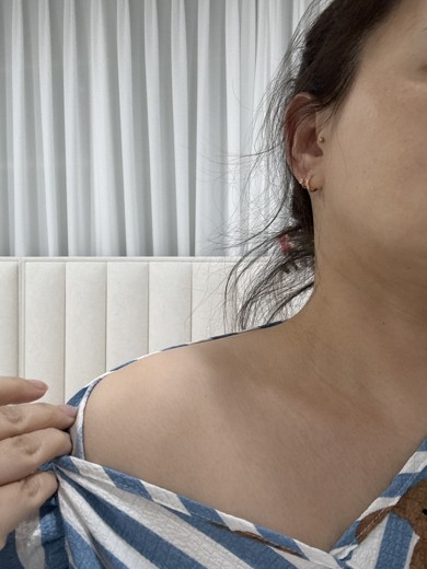 after photo: 승모근보톡스