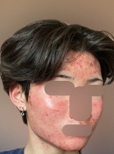 after photo: ダーマペン