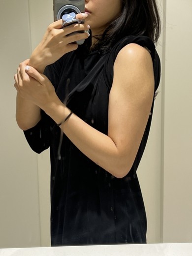 before photo: 팔지방분해주사