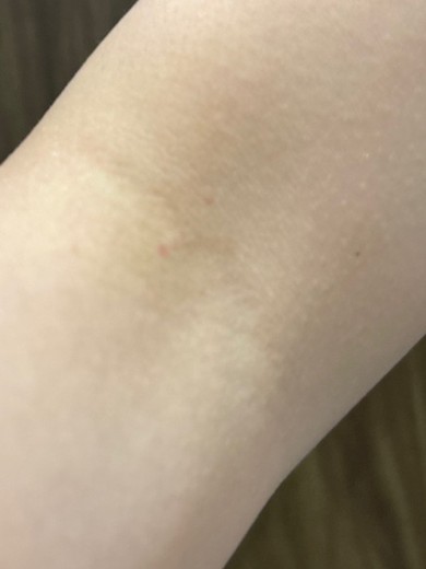 after photo: 白玉注射・点滴