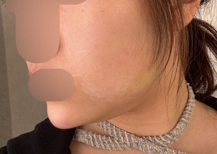 after photo: 턱끝필러