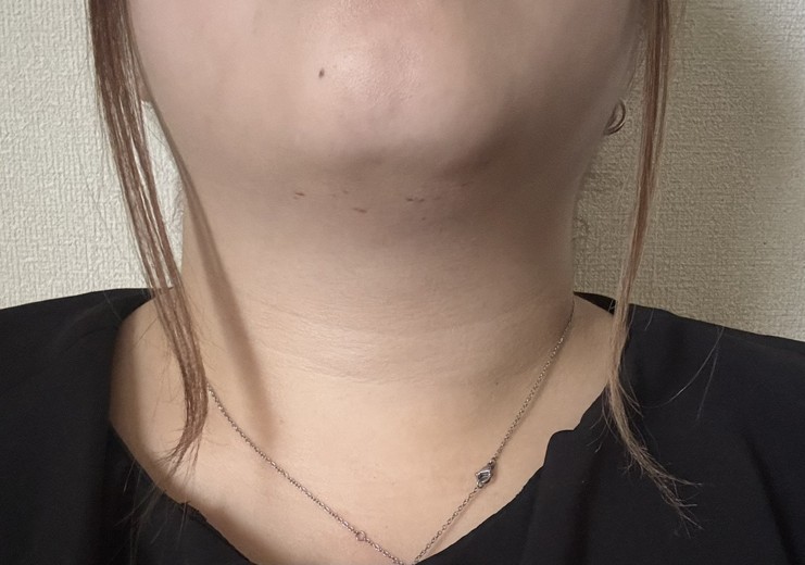 after photo: 脂肪溶解注射(顔)