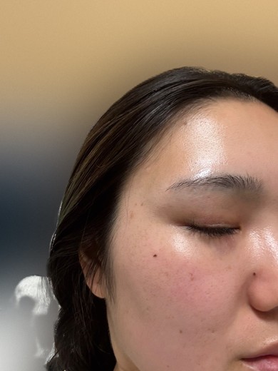 after photo: ダーマペン