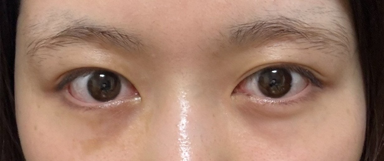 after photo: 目の下脂肪再配置(ハムラ・裏ハムラ法)