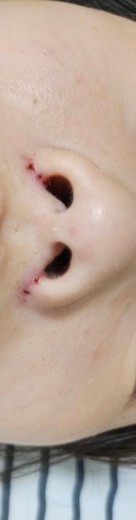 after photo: 콧볼축소