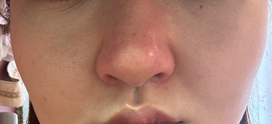 after photo: 小鼻ボトックス, 脂肪溶解注射(顔)