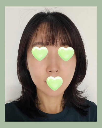 after photo: 티타늄리프팅