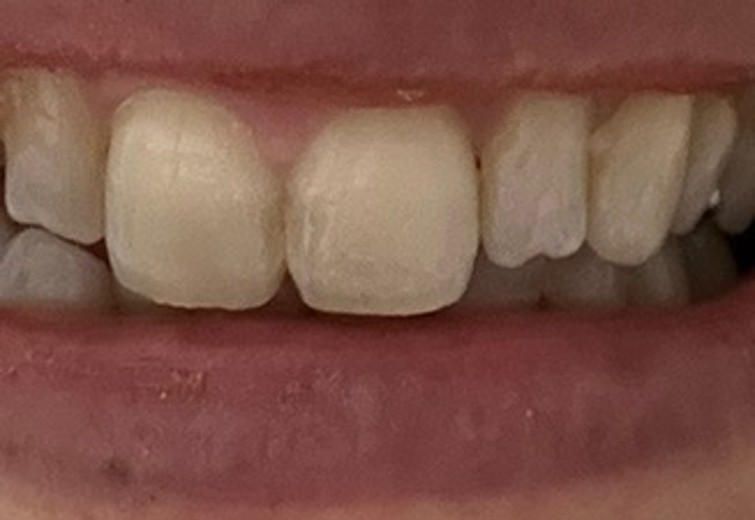 before photo: ホワイトニング