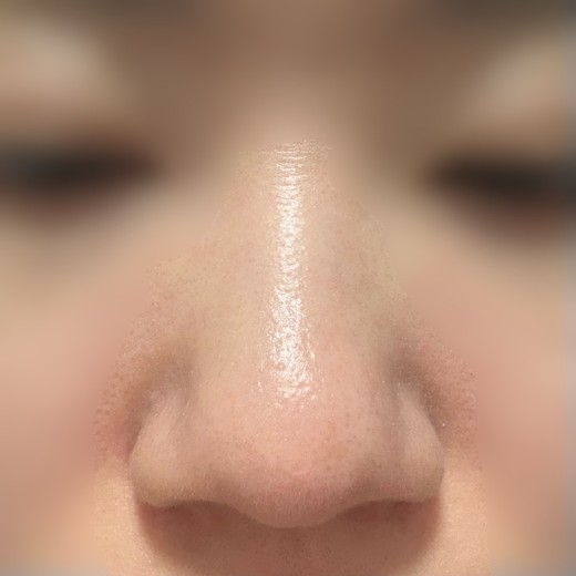 before photo: 콧볼축소, 복코교정(수술)