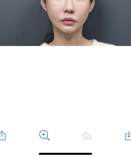 before photo: 실리프팅