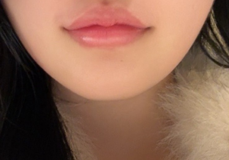 after photo: 입꼬리필러, 입꼬리보톡스, 입술필러