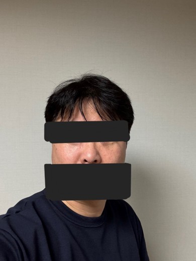 after photo: 눈밑지방재배치