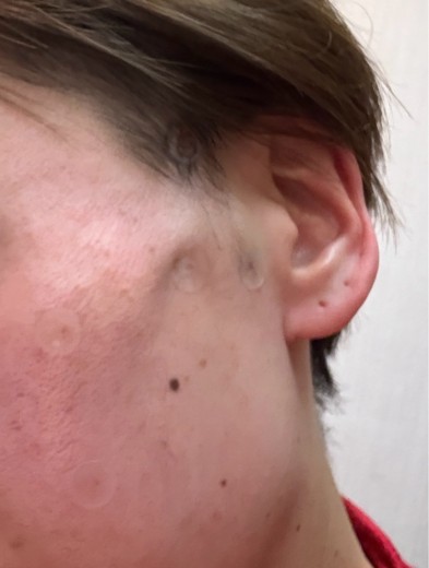 after photo: 糸リフト