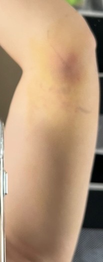 after photo: 脂肪吸引(腕)