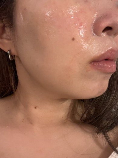 after photo: サーモン注射