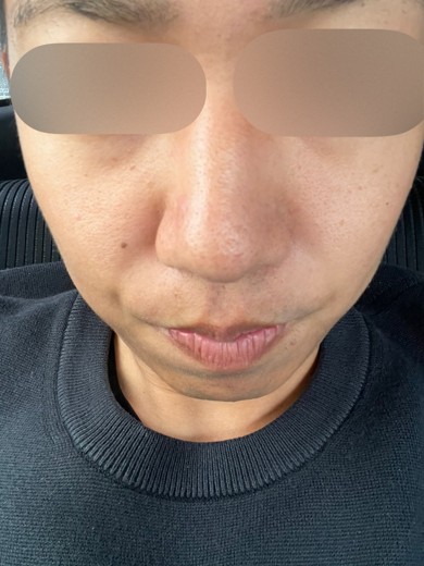 before photo: ダーマペン