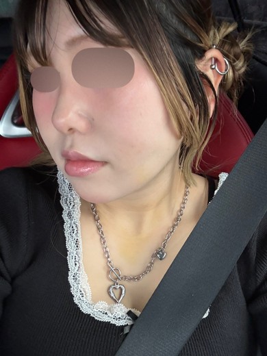 after photo: 糸リフト, 脂肪吸引(顎下), 脂肪吸引(顔), 脂肪吸引(頬)