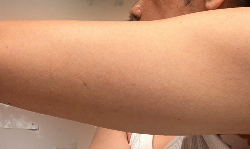 after photo: 脂肪冷却(腕), 脂肪冷却(太もも)