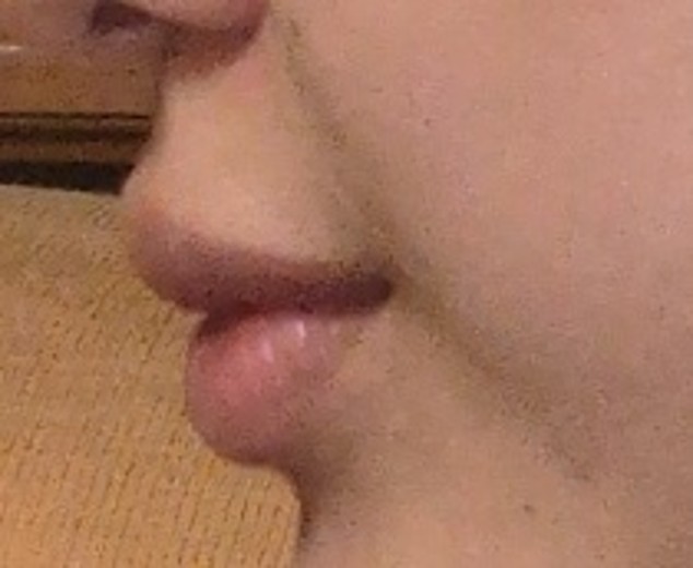 after photo: 唇ヒアルロン酸