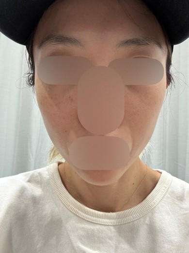before photo: ハイドラフェイシャル, エレクトロポレーション