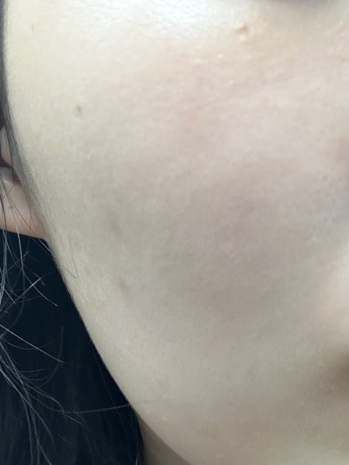 after photo: 여드름압출