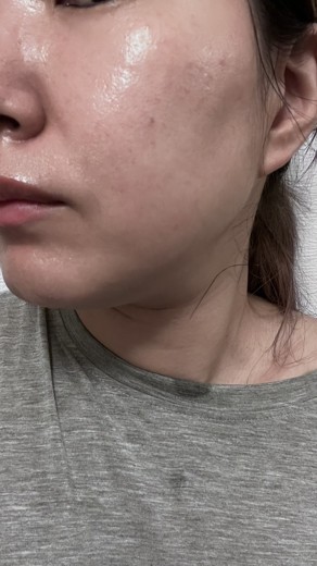 after photo: 診断・検査, ジュベルック(Juvelook)