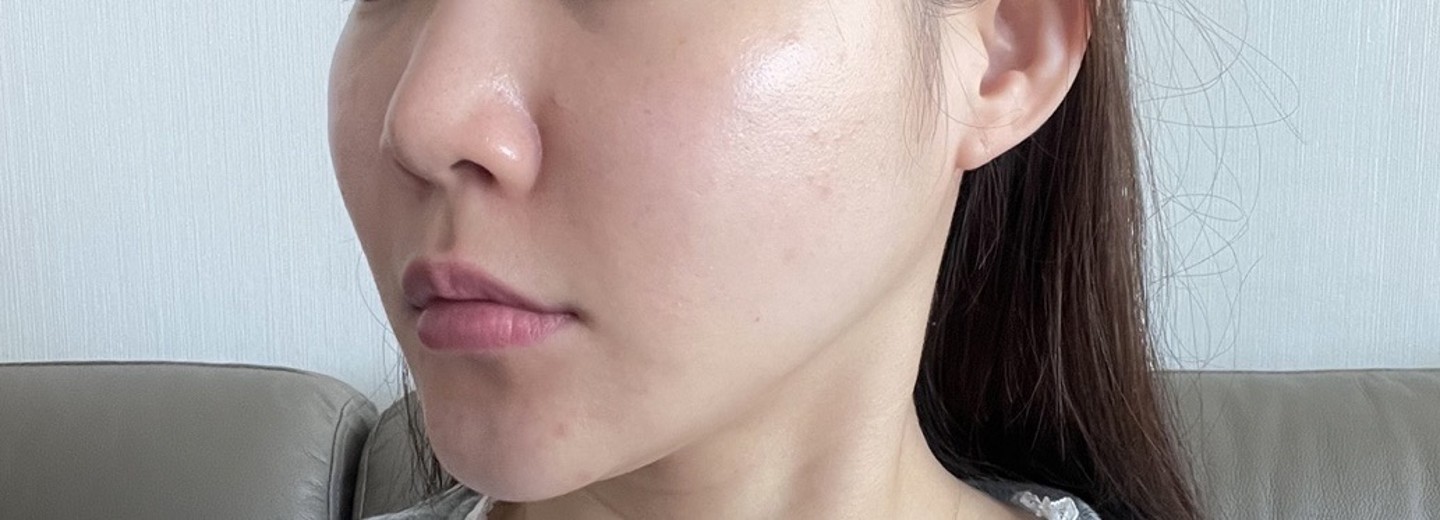 after photo: PRP피부재생술