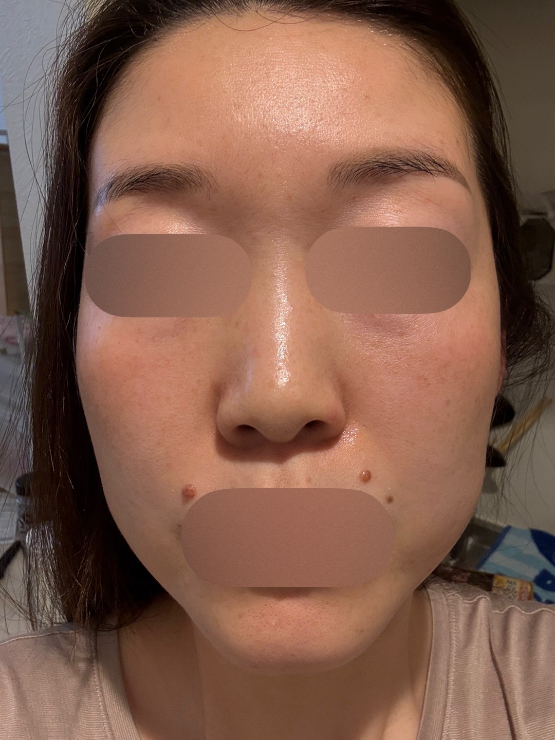 ピコトーニング＋マッサージピール【2月15日迄にご予約頂いた方】 | ZX