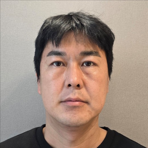 before photo: 눈밑지방재배치