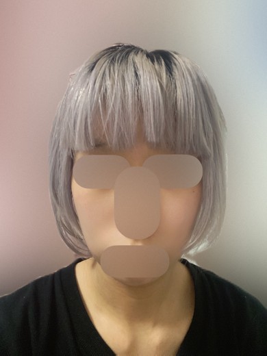 after photo: 首・広頚筋ボトックス