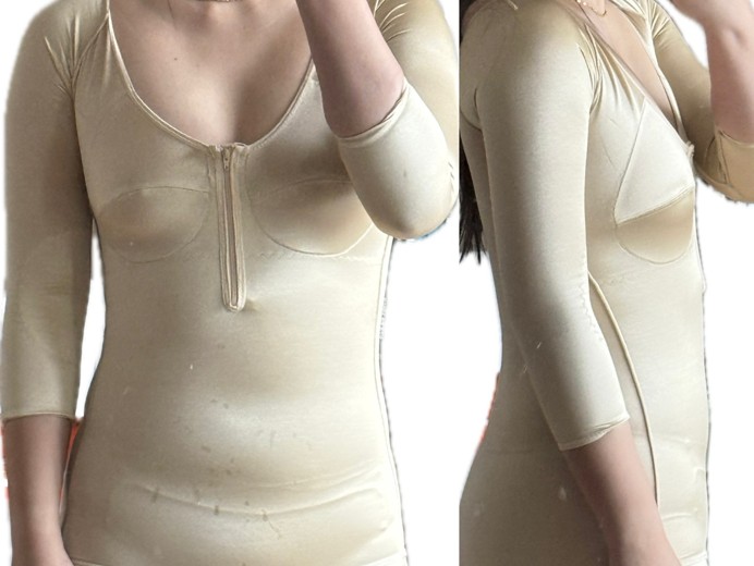 after photo: 팔지방흡입, 옆구리지방흡입, 복부지방흡입, 허리지방흡입