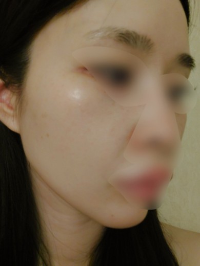 after photo: IPL(光/フォト治療)