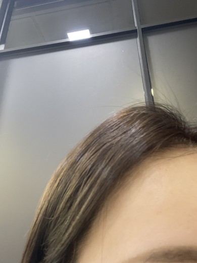 after photo: 여드름압출