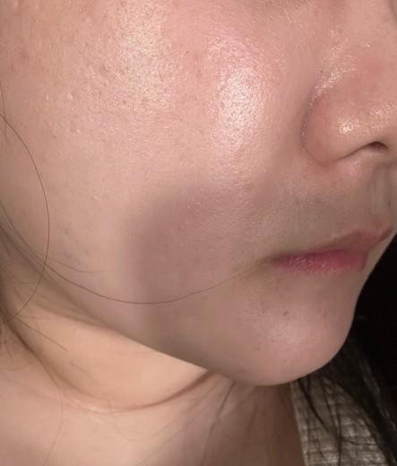 after photo: チタニウムリフト