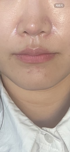 before photo: 팔자주름필러