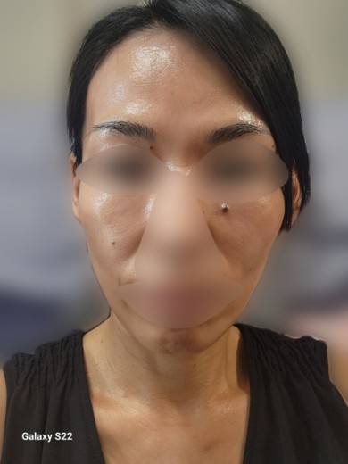 after photo: 水光注射