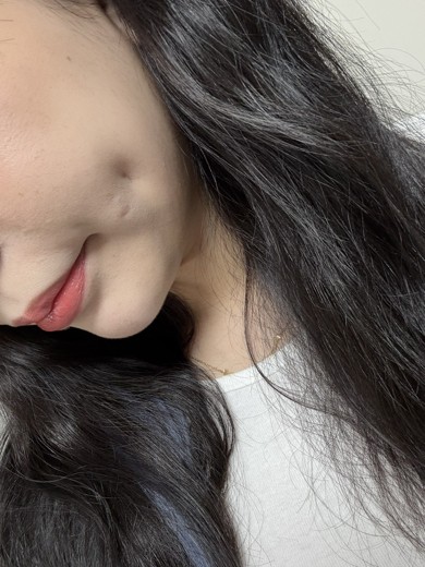 after photo: 보조개성형