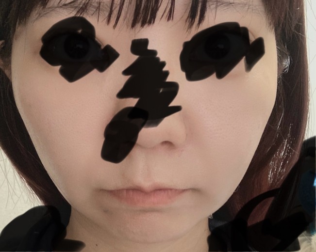 after photo: 糸リフト