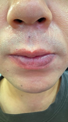 after photo: 아쿠아필링, 수염제모