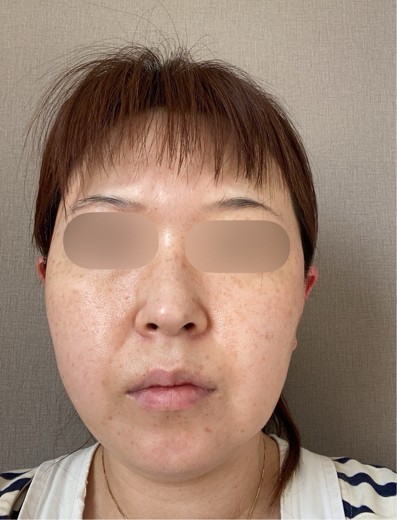 before photo: 脂肪溶解注射(腕), 脂肪溶解注射(顔)