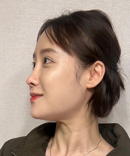 before photo: 윤곽주사